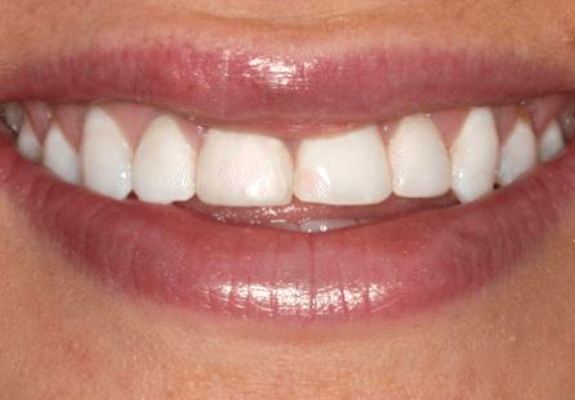 Worn and discolored teeth before cosmetic dentistry
