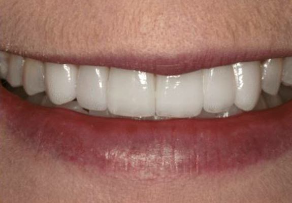 Smile perfected and healthy after restorative and cosmetic dentistry