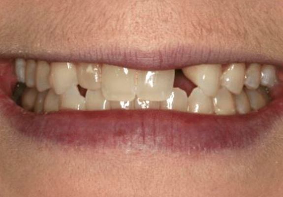 Smile with broken and misaligned teeth before restorative and cosmetic dentistry