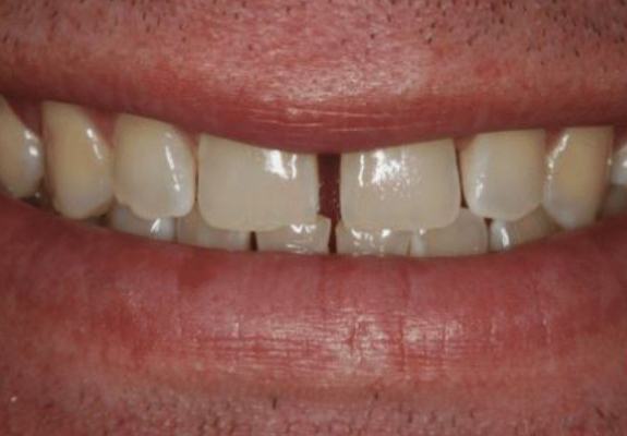 Gap between front teeth and discolored smile before porcelain veneers