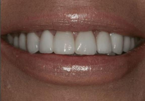 Smile after front teeth were corrected with cosmetic dentistry