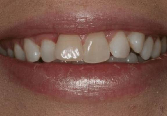 Damaged and misaligned front teeth