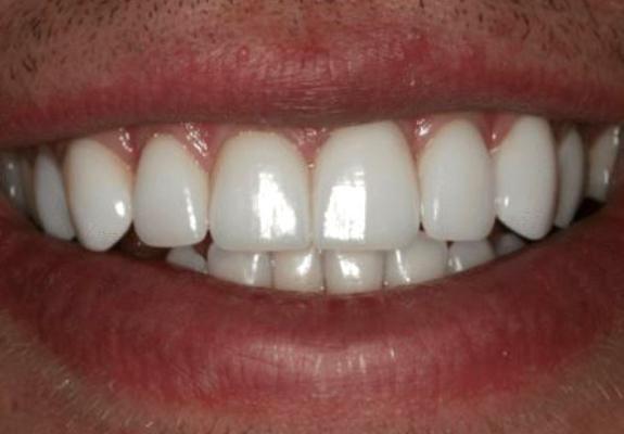 Evenly spaced and aligned smile after cosmetic dentistry