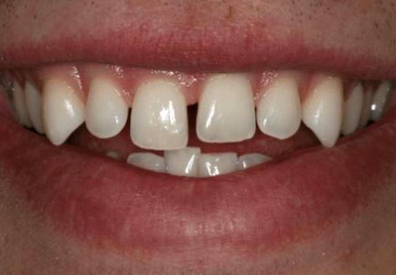 Gaps and misaligned teeth before cosmetic dentistry