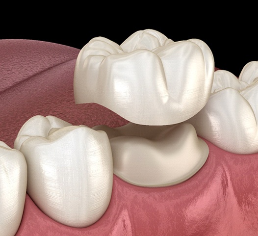 computer illustration of a dental crown being placed on a tooth
