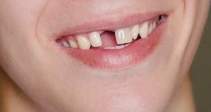 Smile with missing front tooth