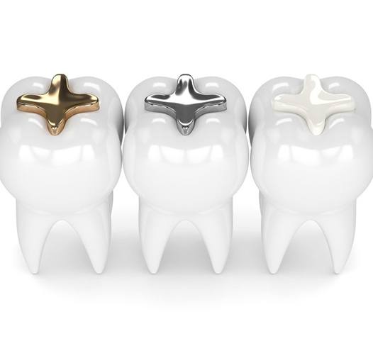 teeth with gold, silver, and tooth-colored fillings 