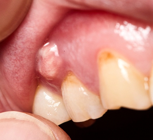 An individual’s exposed top gums that show a pocket of pus signaling an abscess