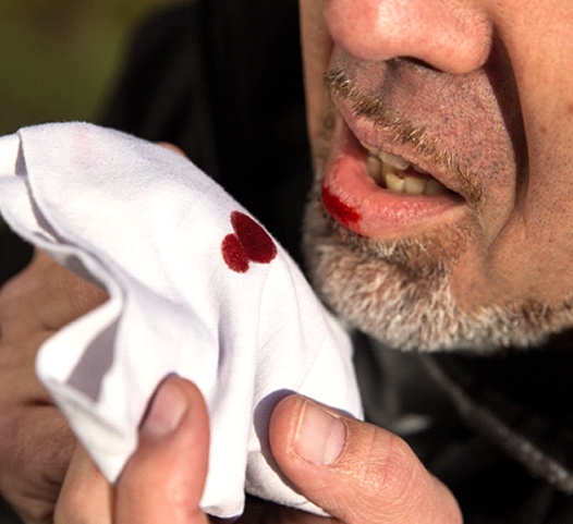 An older man holding a handkerchief up to his bleeding lip