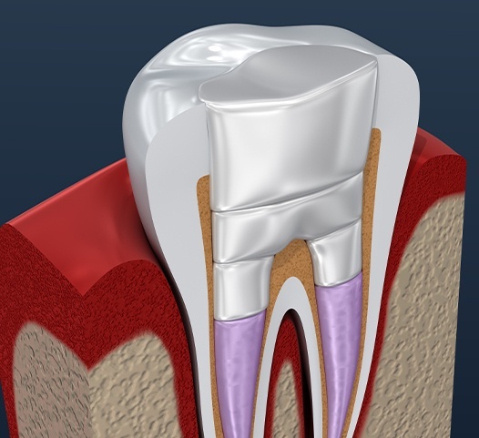 Animated tooth after root canal treatment